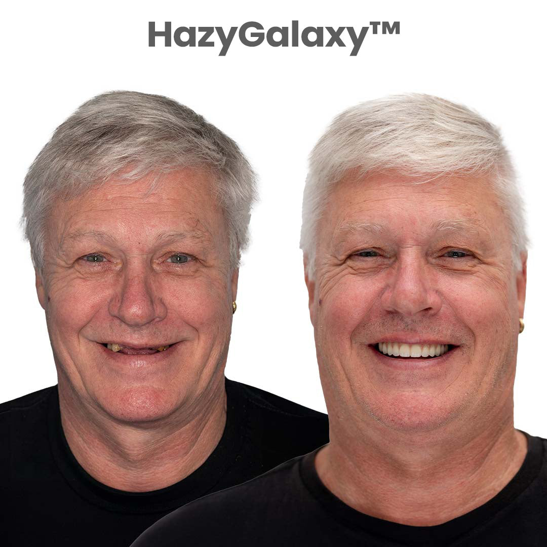 --🦷 HazyGalaxy™ Custom-Fit Dentures ⏰ ENDS TODAY   75% OFF | Smile with Confidence